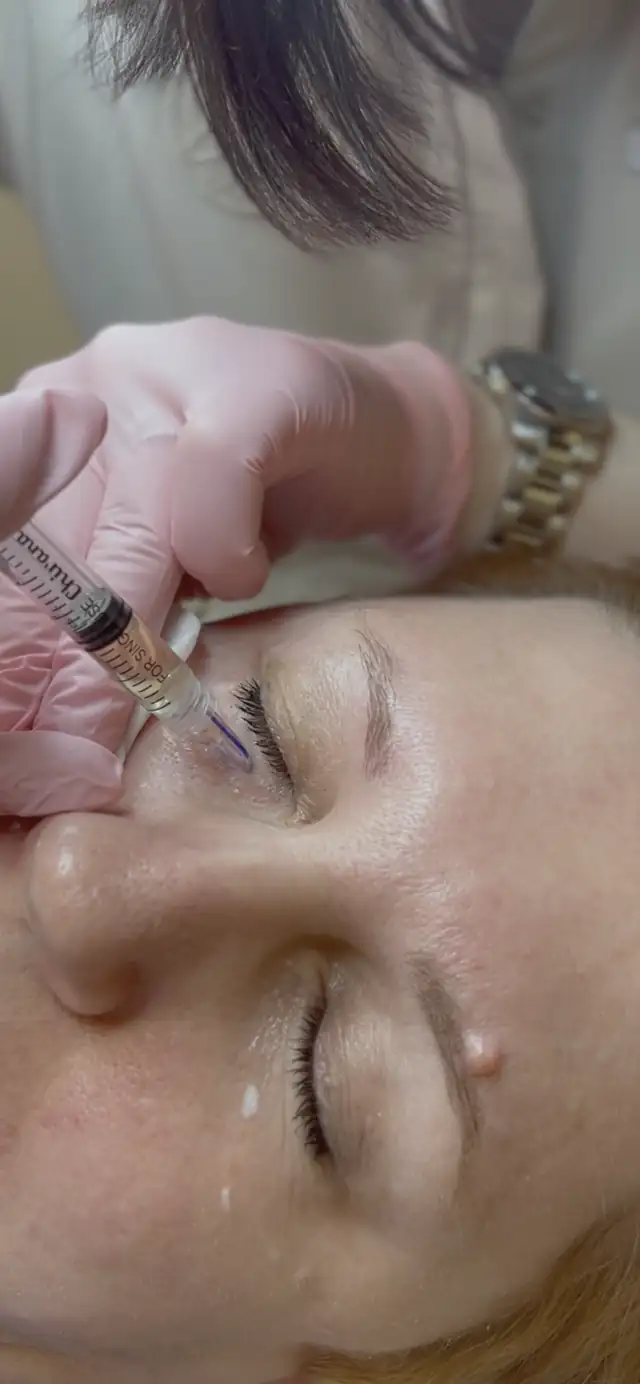 Mezoterapia okolicy oka w Quality House of Beauty