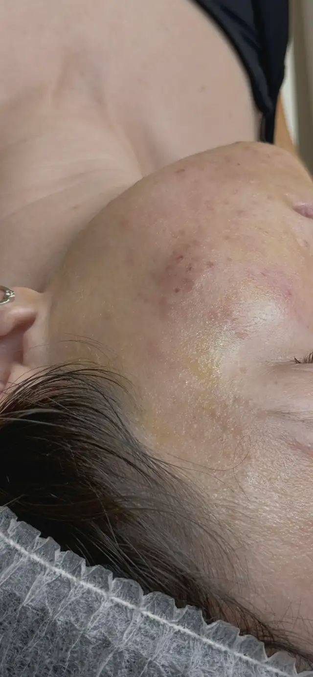 Peeling chemiczny w Quality House of Beauty
