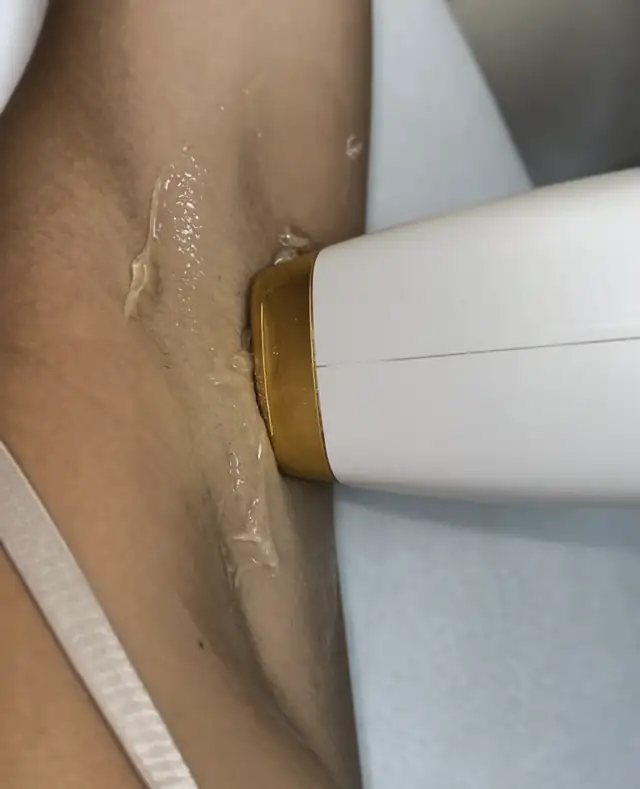 Depilacja laserowa w Quality House of Beauty