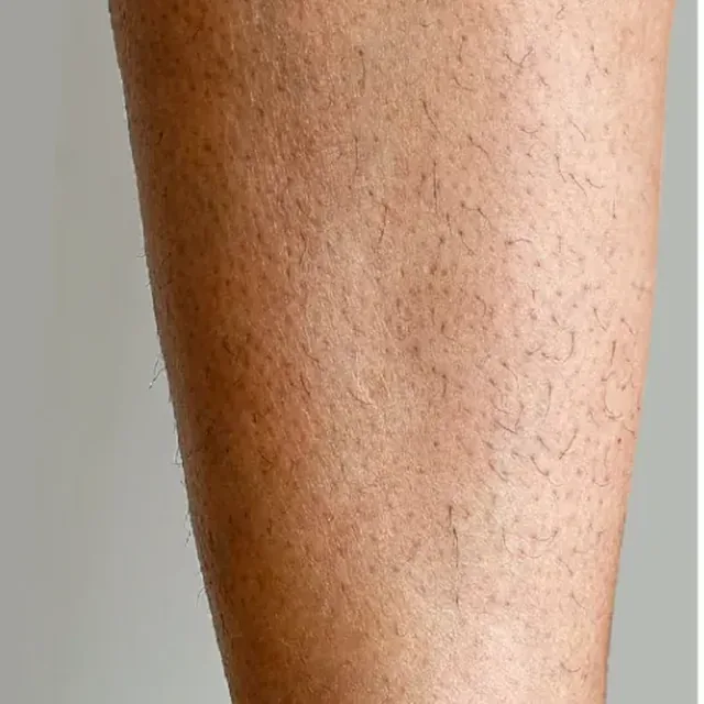 Przed zabiegiem