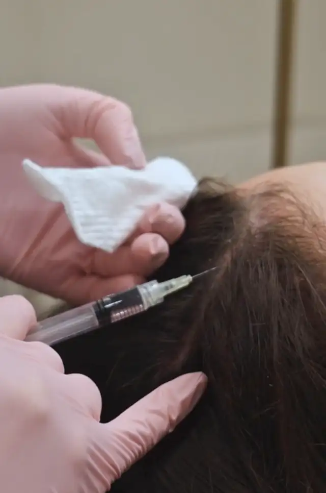 Mezoterapia skóry owłosionej głowy w Quality House of Beauty