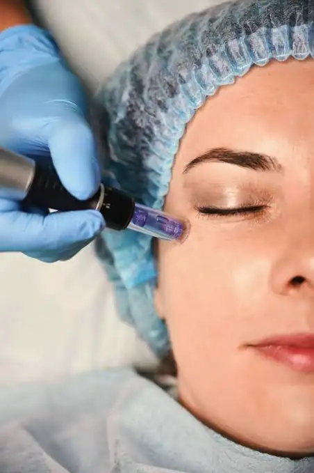 Dermapen w Quality House of Beauty