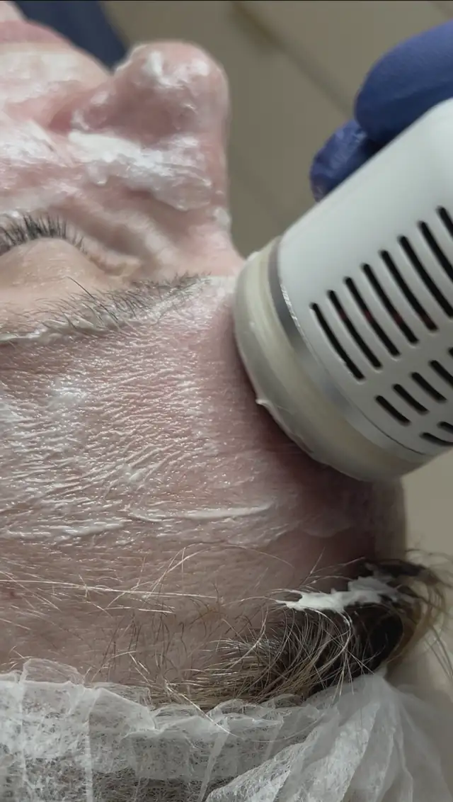 Peeling kawitacyjny + Sonoforeza w Quality House of Beauty