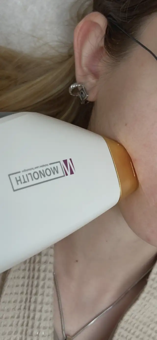 Laserowe leczenie trądziku Mediostar Monolith w Quality House of Beauty