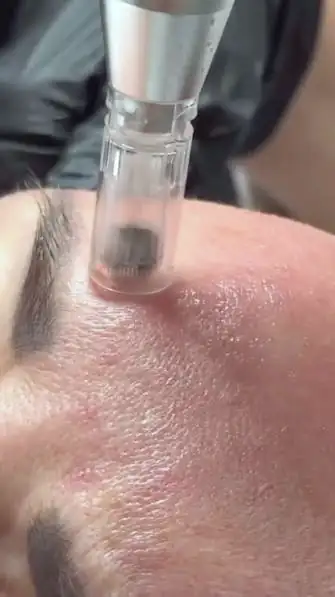 Dermapen w Quality House of Beauty