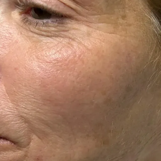 Before the treatment