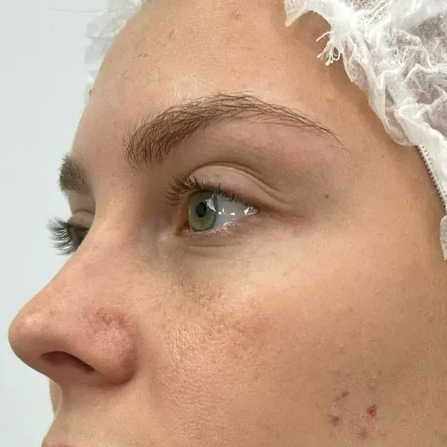 Before the treatment